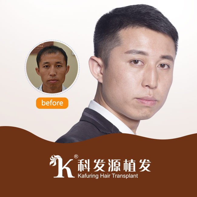 株洲哪里有植發(fā)的圖片