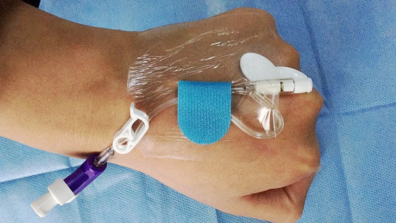 導(dǎo)管固定圖片/導(dǎo)管固定樣板圖 (3)