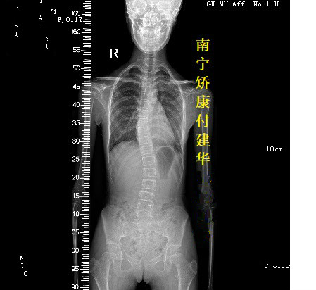 南宁市广西脊柱侧弯支具厂家