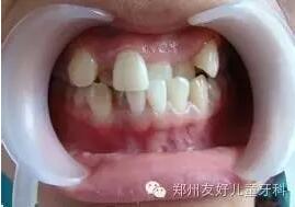 換牙期孩子 牙齒不齊需要矯正嗎