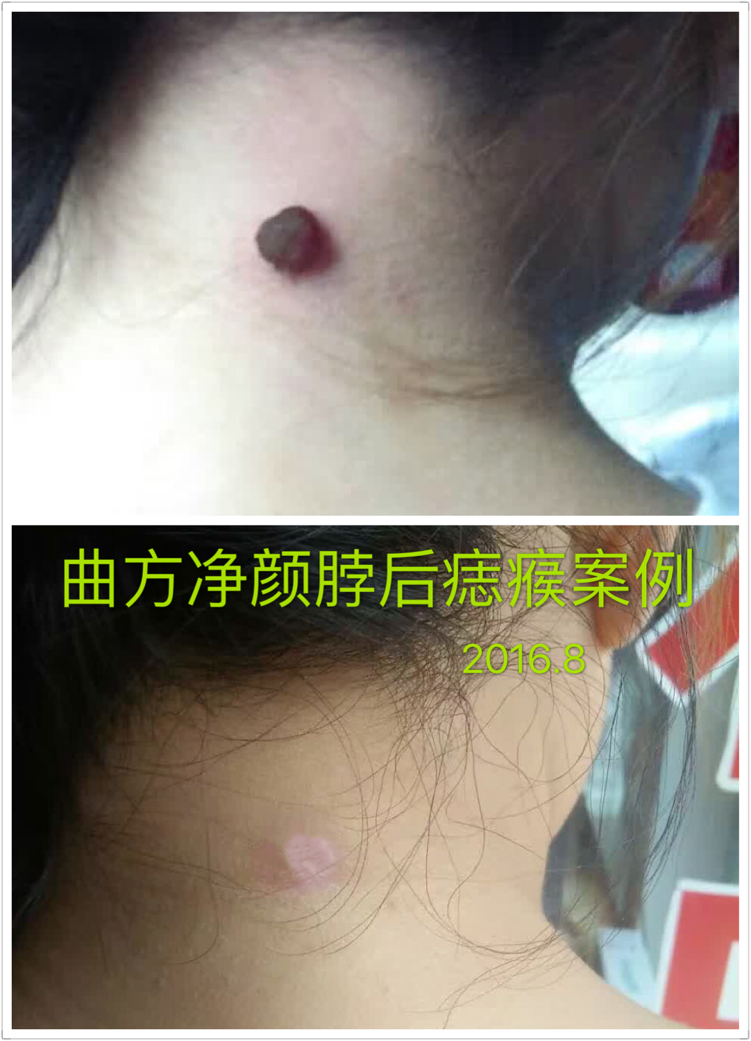曲方凈顏祛斑