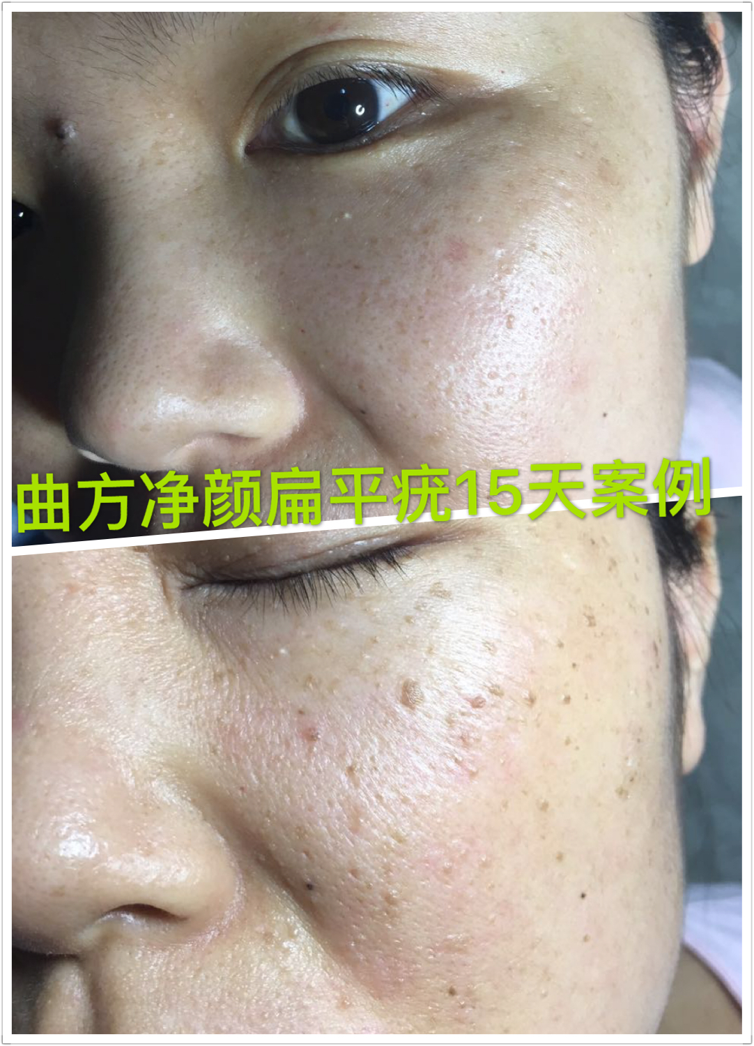 曲方凈顏祛斑*祛痘