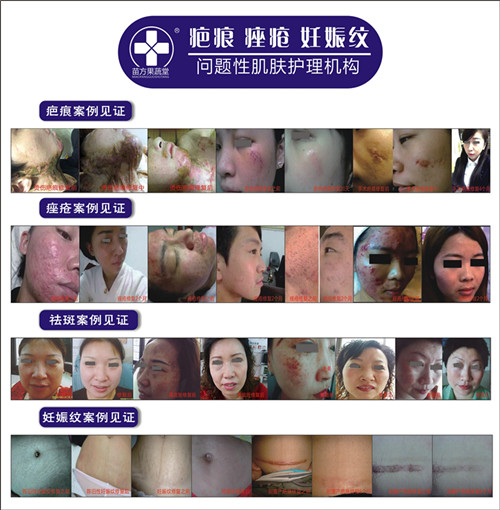 祛斑不蛻皮后期無色素回流點雀斑、老年斑 美白祛斑修復(fù)