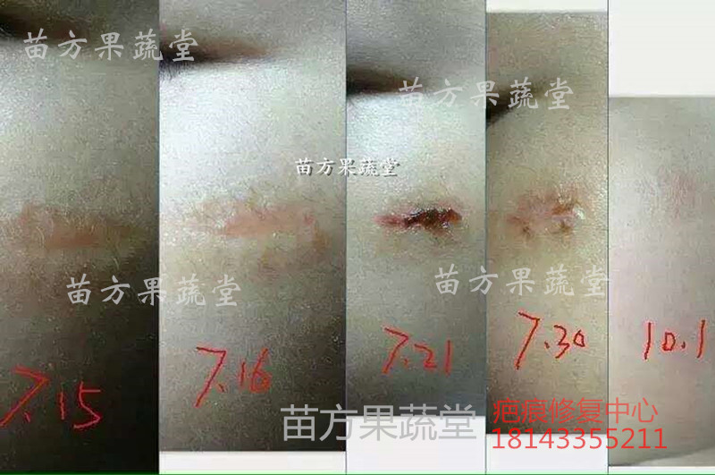 *去除用什么品牌好 湖南苗方果蔬堂*痕修復(fù)精華
