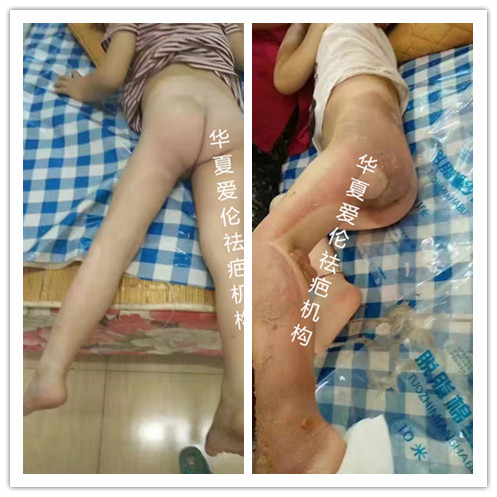 重慶專業(yè)無痕*  簽約*  沒有華夏愛倫無法*的* 重慶*醫(yī)院