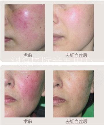 西安瀾海光電中心980凈絲儀原理及功效 980凈絲儀祛紅血絲