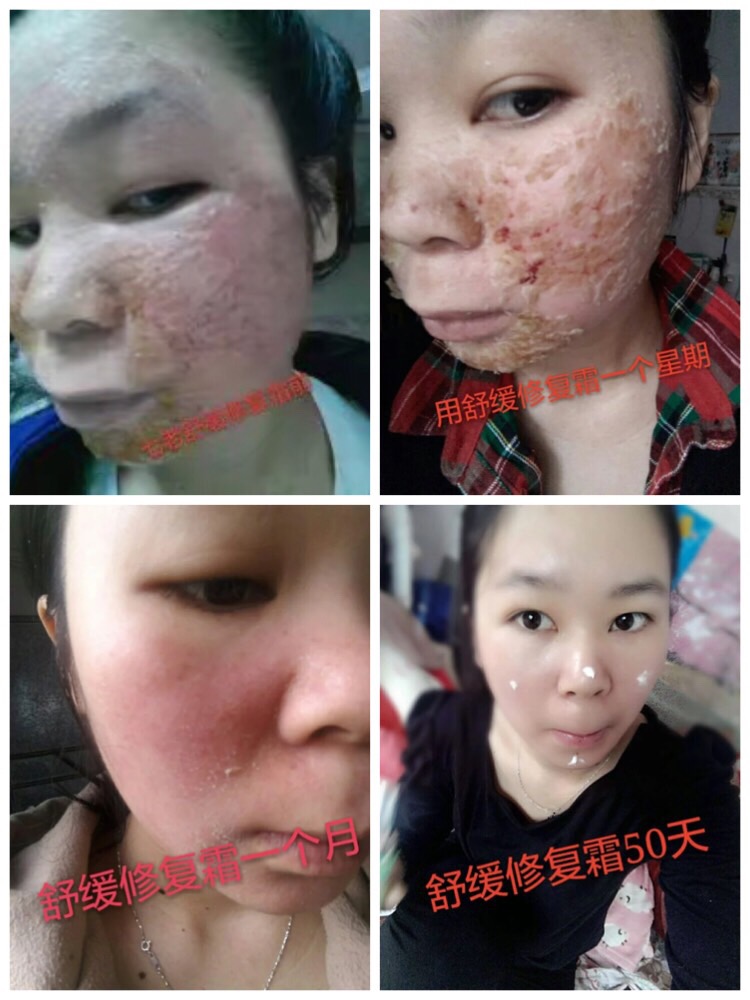 都是*臉惹的禍，差點(diǎn)毀了我的一切、幸虧有它讓我恢復(fù)了自信 七老親肌嫩膚系列