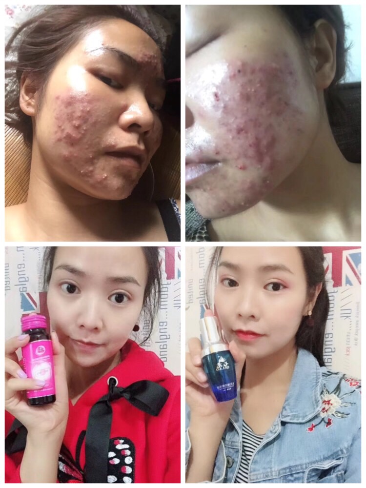 都是*臉惹的禍，差點(diǎn)毀了我的一切、幸虧有它讓我恢復(fù)了自信 七老親肌嫩膚系列